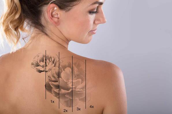 The back of a woman right before the beginning of a laser tattoo removal session